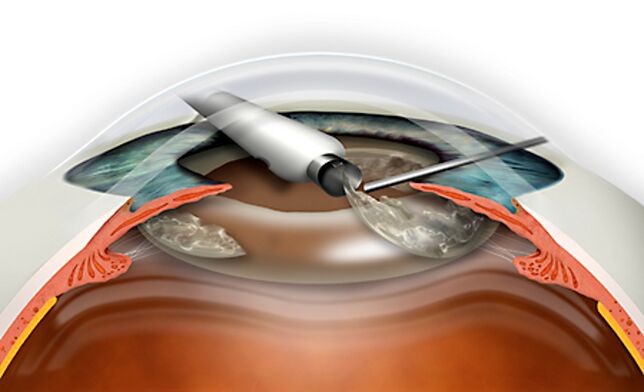 The lens refractive replacement is done by a micronade that excludes blood loss
