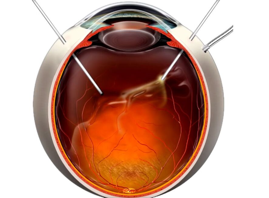 Vittectomy - a procedure shown to people when the retina exfoliates